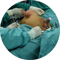 Laparoscopic Hernia