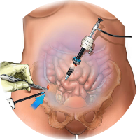 Laparoscopic Intestinal Surgeries