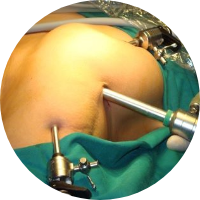 Laparoscopy Surgery