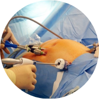 Laparoscopic Gallbladder Surgery